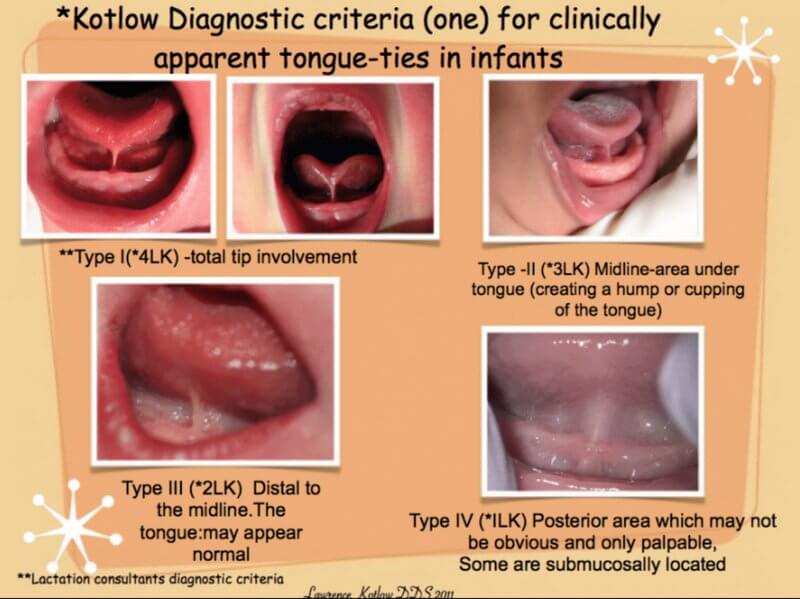 dummies for tongue tied babies