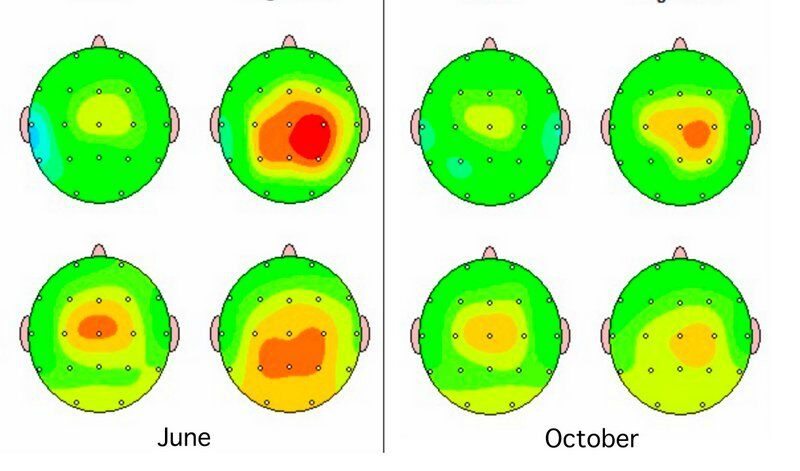 benefits of neurofeedback q EEG brain mapping