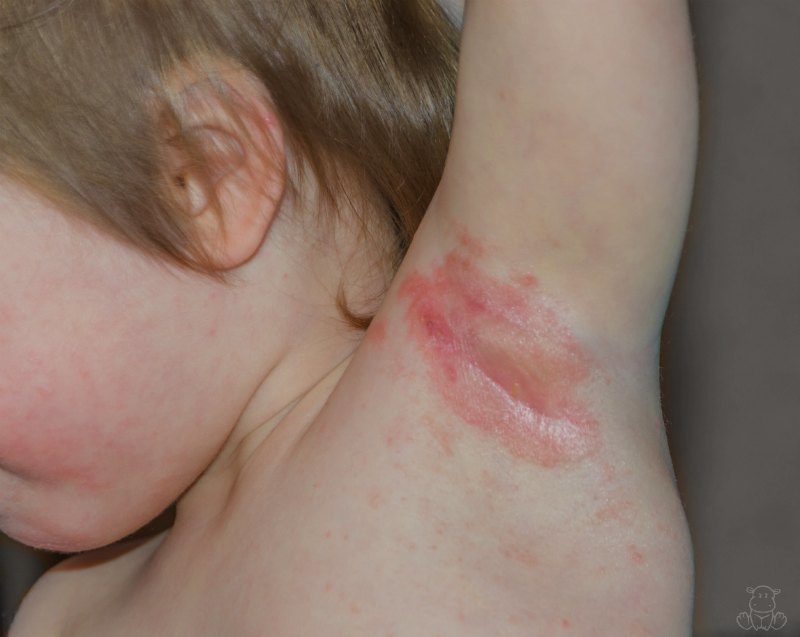 Yeast Diaper Rash (Candida Diaper Dermatitis): Symptoms, Causes, Treatments